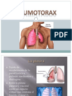 Neumotorax