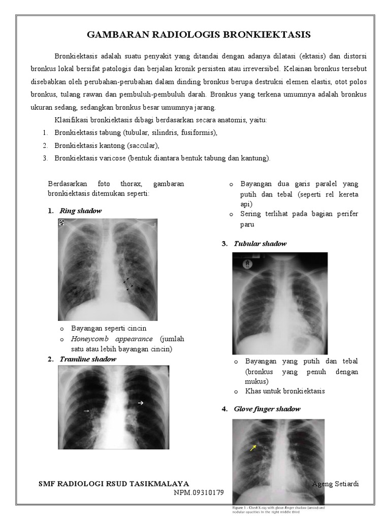 Gambaran Radiologis Bronkiektasis | PDF
