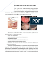 Transurethral Resection of The Prostate