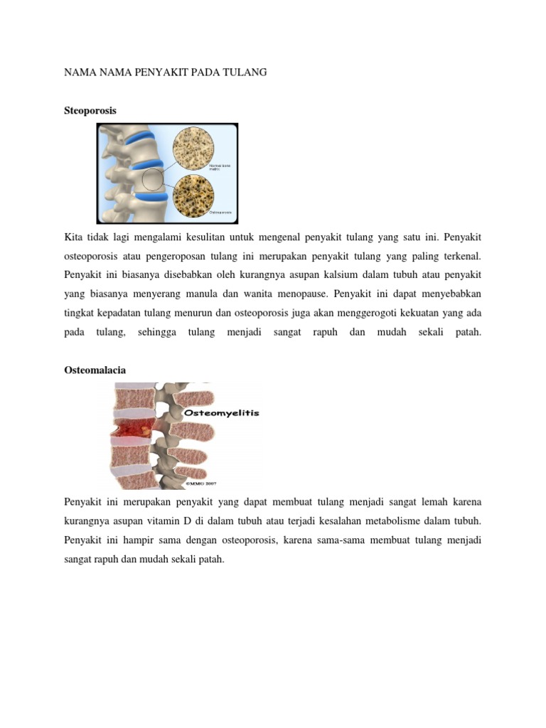 Penyakit Tulang Akibat Kekurangan Vitamin D Disebut Terbaru