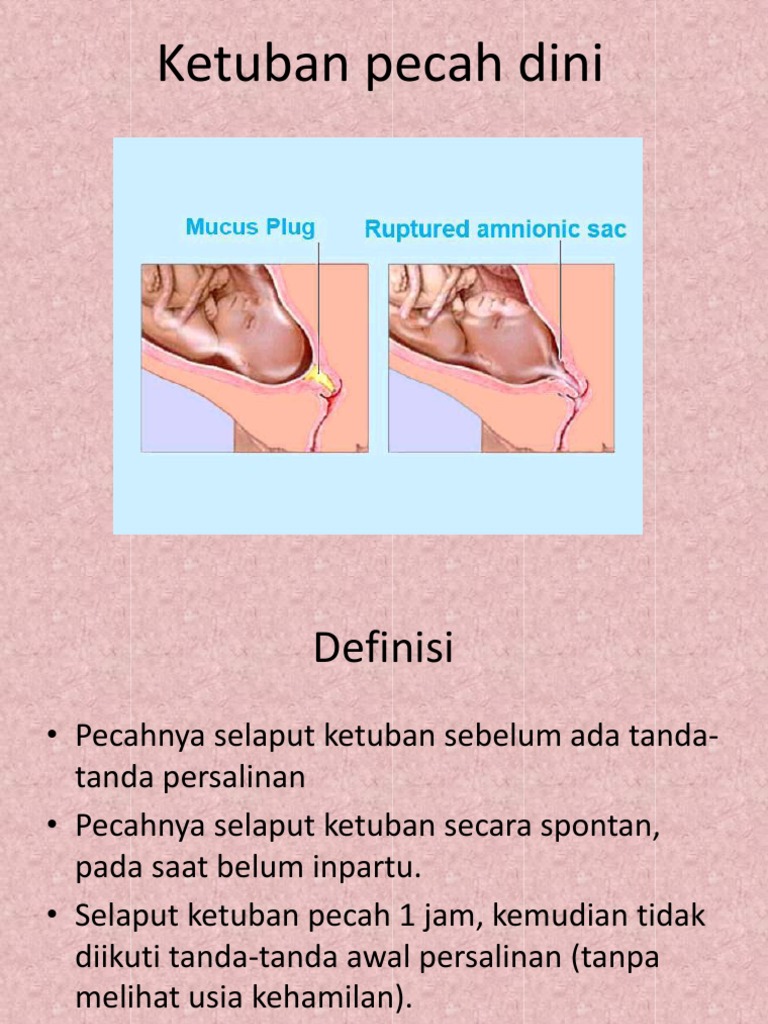 Ketuban Pecah Dinippt