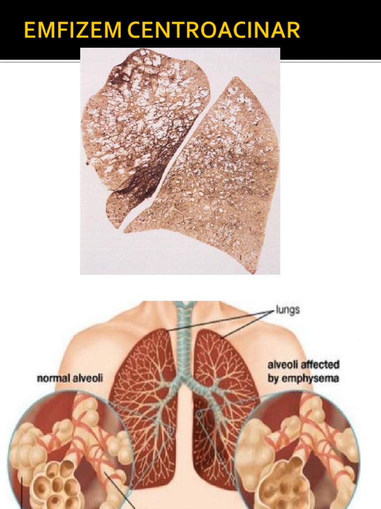 Emfizem Pulmonar | PDF