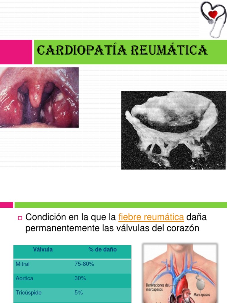 Cardiopatia Reumatica PDF Enfermedades cardiovasculares Rtt