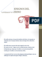 Tumores Benignos Del Cuello Uterino