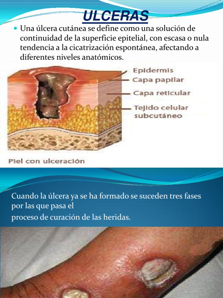tipos-y-tratamiento-de-lceras-cut-neas-pdf