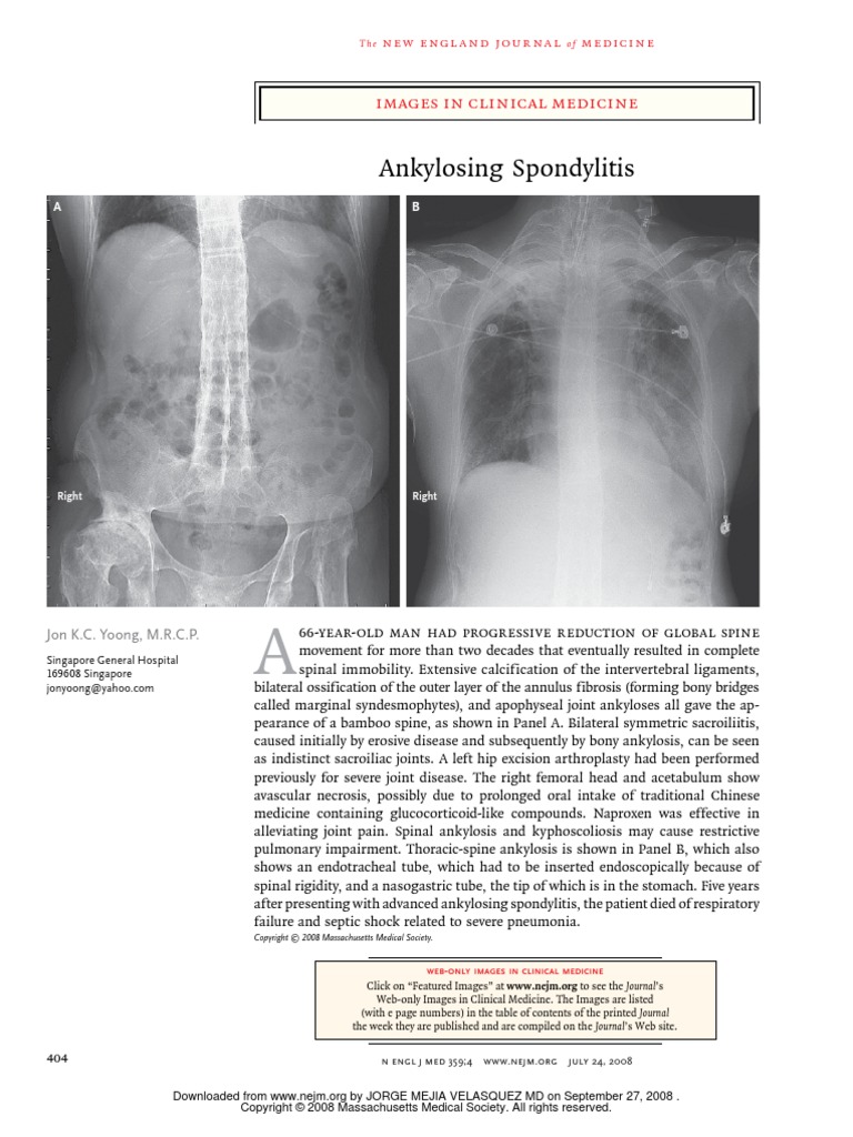 Ankylosing Spondylitis NEJM 2008 | PDF | Self-Improvement | Wellness