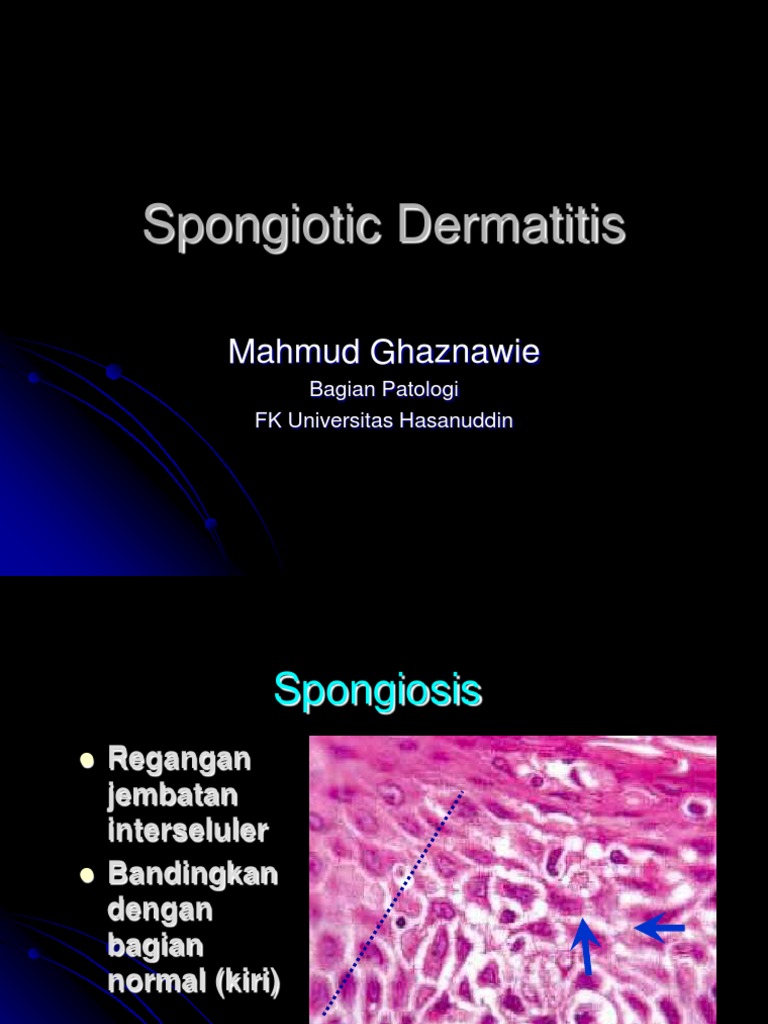 The Unexpected Link Between Spongiotic Dermatitis And Lupus - tdxqbeg