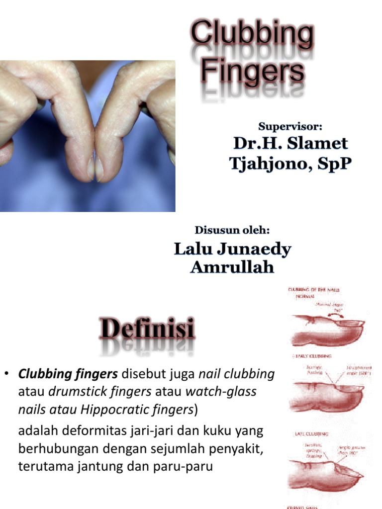 Clubbing Fingers PDF