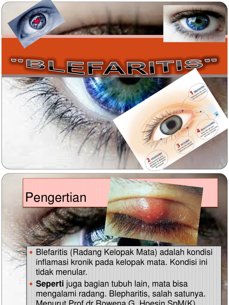 BLEFARITIS | PDF | Kajian Bahasa Asing | Kesehatan Holistik