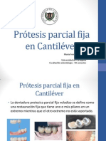 Prótesis parcial fija en Cantiléver