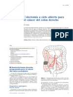 Colectomia A Cielo Abierto para El Cancer de Colon Derecho