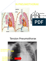 Mer Tension Pneumothorax