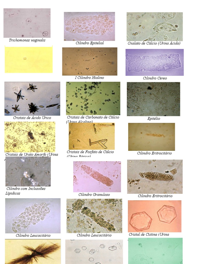 tipos-de-cilindros-e-cristais-na-urina-pdf
