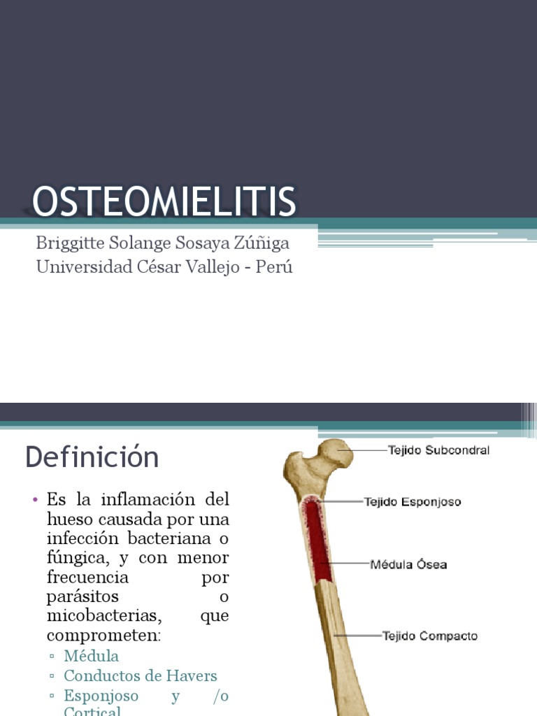 Osteomielitis | Hueso | Inflamación