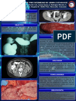 Resección intestinal por estenosis en enfermedad de Crohn