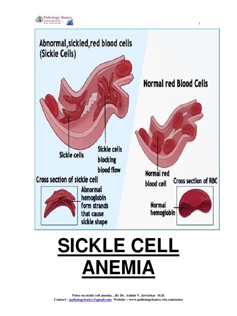 Sickle Cell Anemia | PDF | Sickle Cell Disease | Anemia