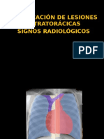 Localizacion de Lesiones Pulmonares