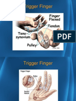 6 Trigger Finger