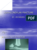 Supracondylar Fracture