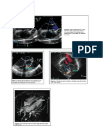 Ekokardiografi Dan MRI Penyakit Jantung Bawaan Asianotik VSD