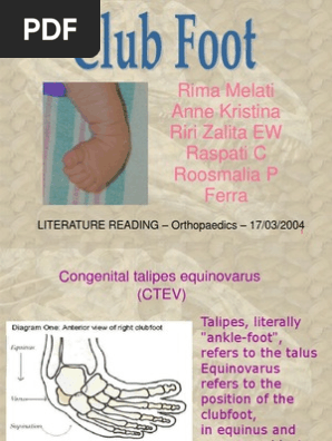 Club Foot Pdf Foot Orthopedic Surgery