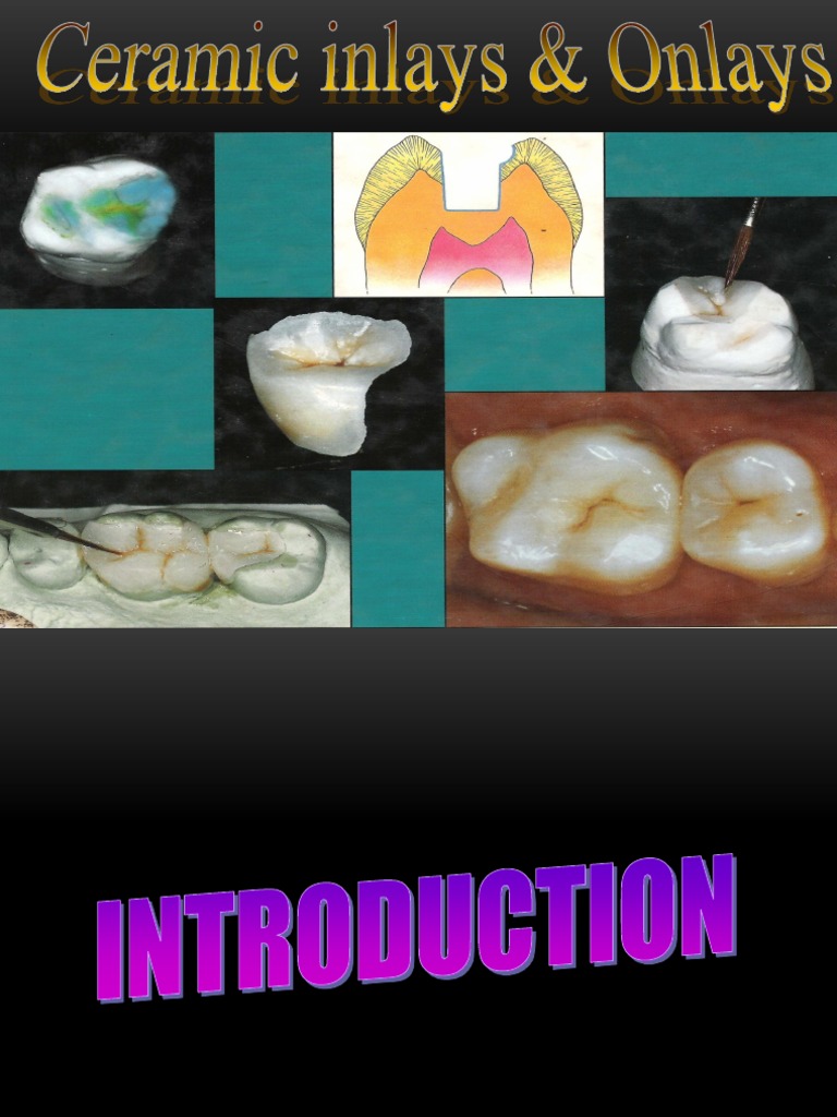 Inlay Onlay Pdf – Inlays and Onlays – HQCWDZ