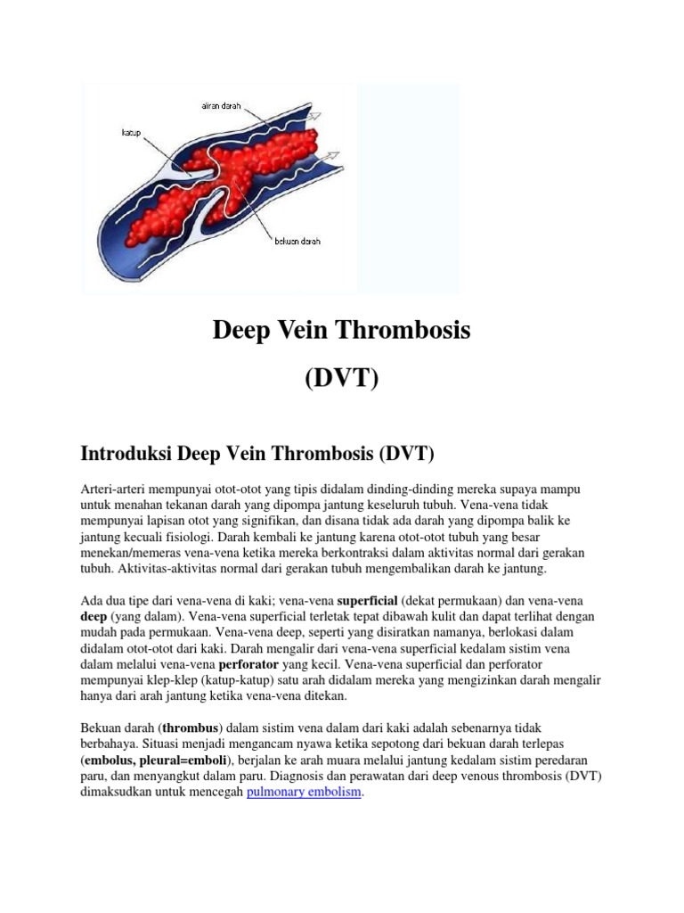 DVT | PDF