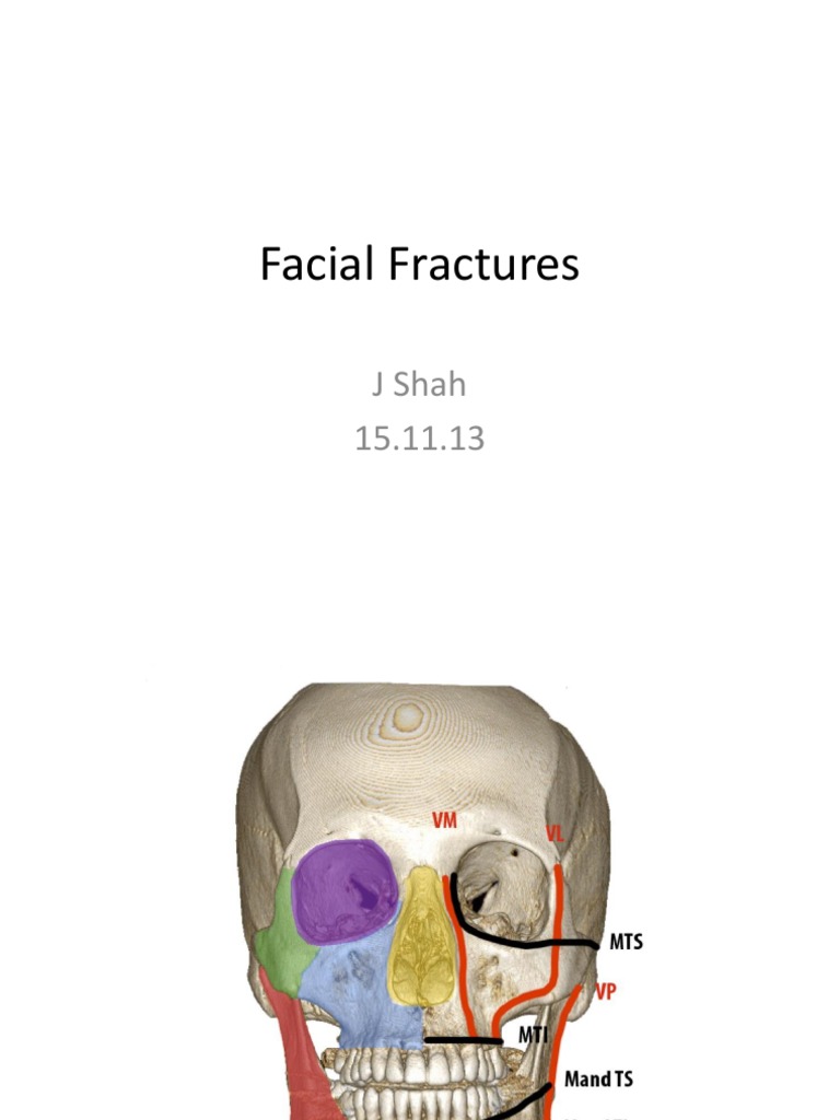 Types and Classification of Facial Fractures | PDF | Science & Mathematics