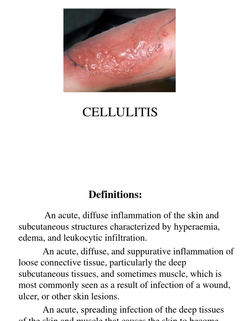 Cellulitis Methicillin Resistant Staphylococcus Aureus Clinical Medicine