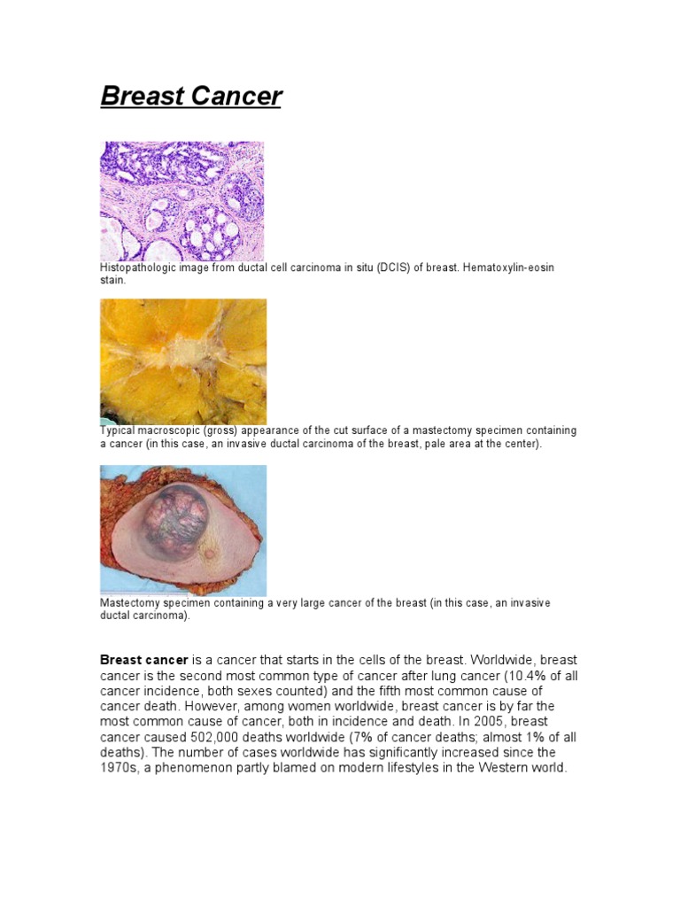 Breast Cancer | PDF | Mastectomy | Breast Cancer