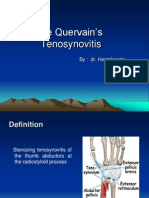 De Quervain's Tenosynovitis: By: Dr. Hermilawaty