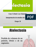 Atelectasias