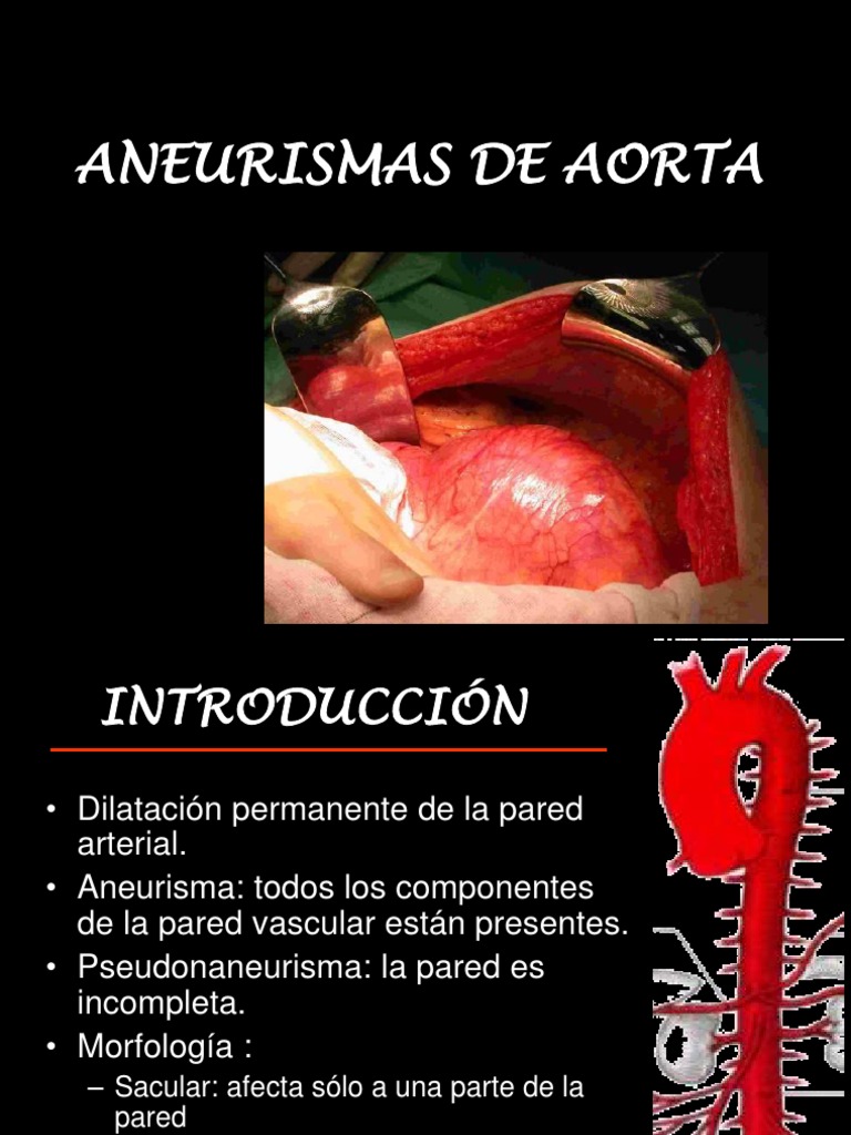 Aneurismas De Aorta Copy2 1 Aorta Abdomen