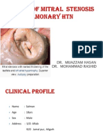 A Case of Mitral Stenosis
