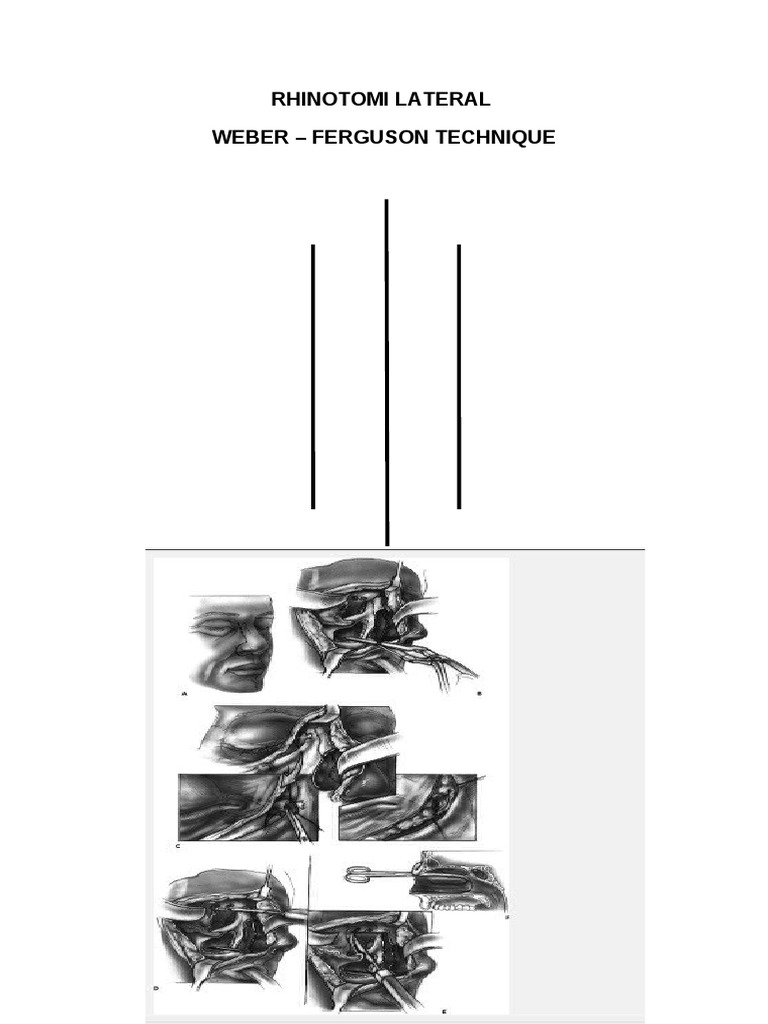 Lateral Rhinotomy: Weber-Ferguson Technique | PDF | Primate Anatomy ...