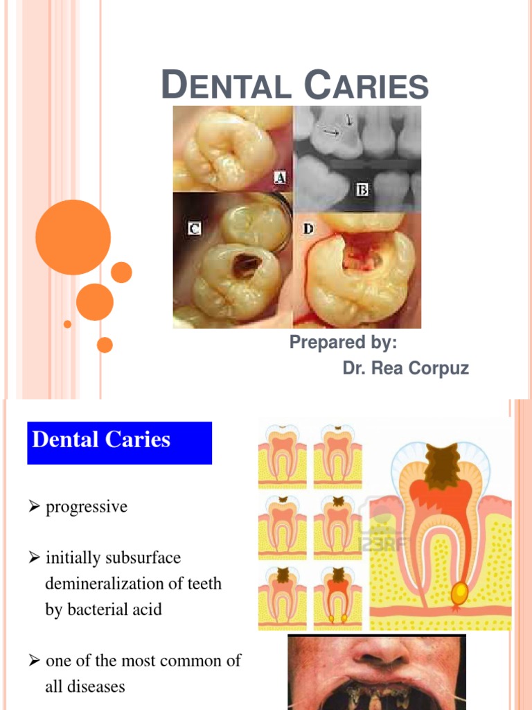 Understanding Dental Caries Etiology | PDF | Tooth Enamel | Human Tooth