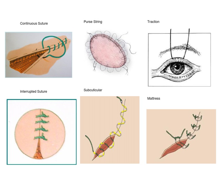 Suture Techniques Overview | PDF