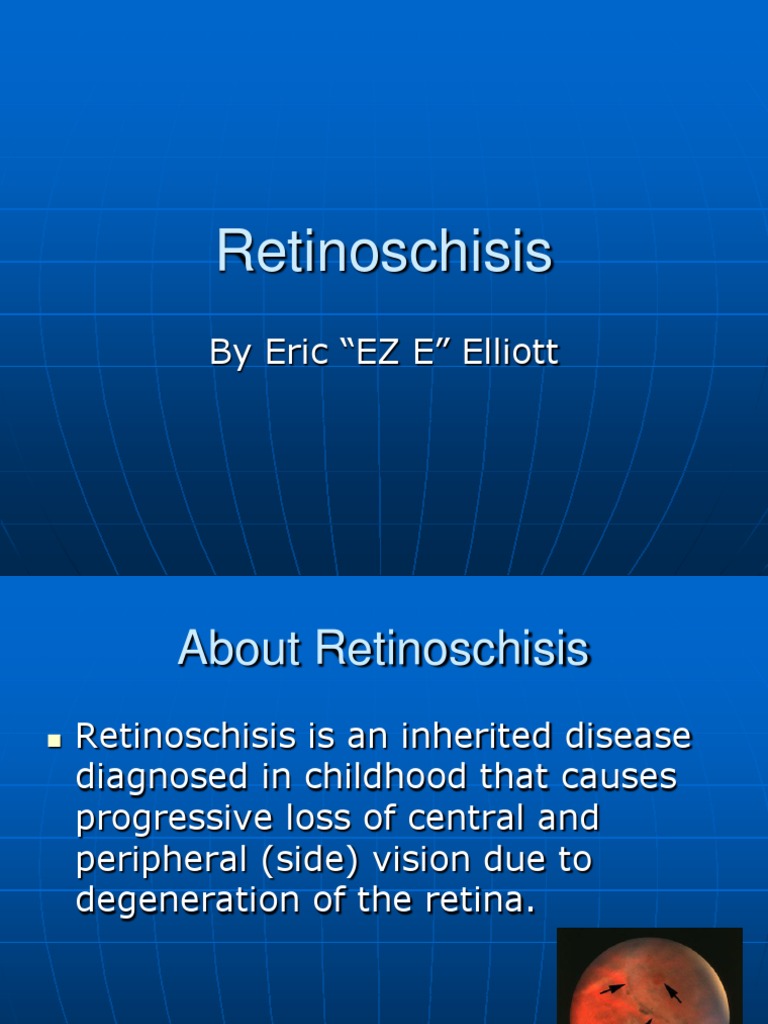 Retinoschisis | PDF