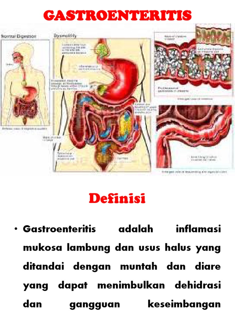 Definisi dan Gejala Gastroenteritis | PDF