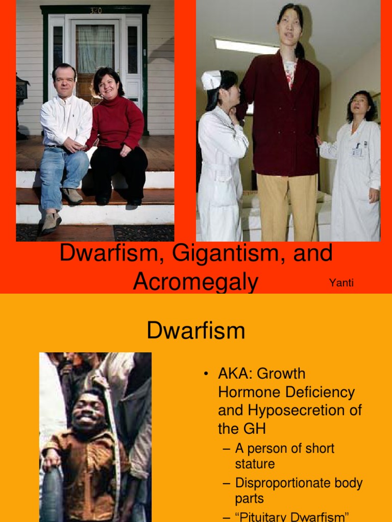 pituitary gigantism vs acromegaly