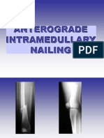 Anterograde Itramedulary Nailing.