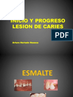 Progreso y tipos de lesiones en esmalte, dentina y cemento