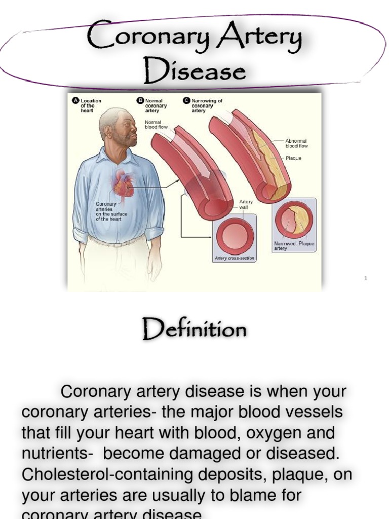 Understanding Coronary Artery Disease | PDF | Myocardial Infarction ...