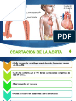 Coartacion de Aorta