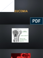 Leucemia