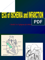 ECG, Ischemia,MCI.ppt