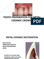 Metal Ceramic Restoration