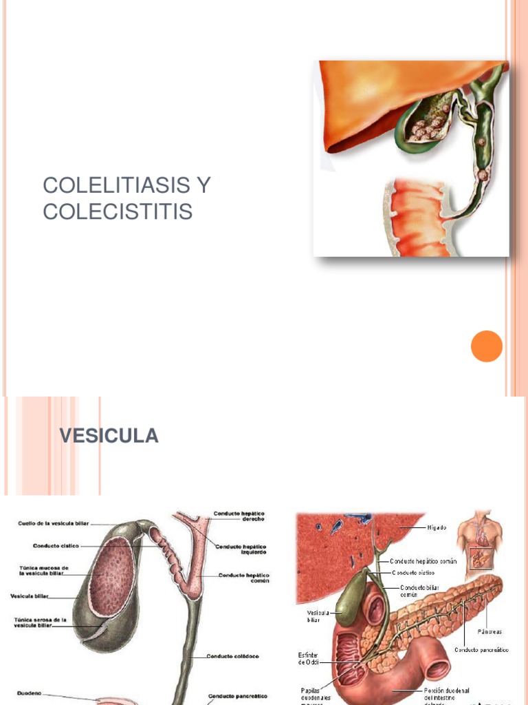 Colestasis Colelitiasis PDF Especialidades Medicas Enfermedades