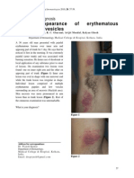 13.PhotodermDiagnosis Sudden Appearance of Vesicles in An Adult