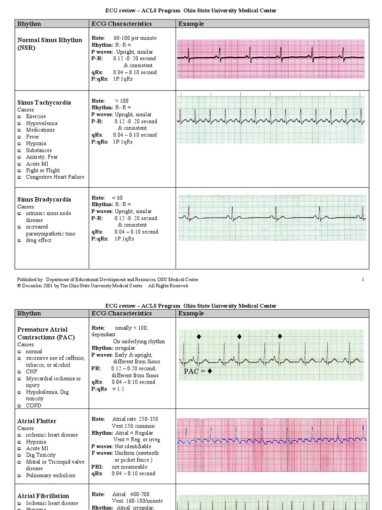 EKG Examples